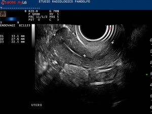 Ecografia endo-vaginale