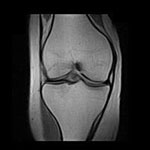 Risonanza Magnetica ginocchio