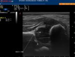 Ecografia dell'anca neonatale