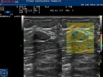 Elastosonografia nodulo mammario