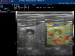 Elastosonografia nodulo tiroideo