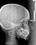Teleradiografia del cranio