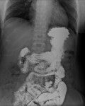 Rx apparato digente con MdC