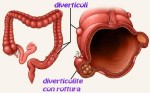 Diverticoli