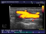 Eco-color Doppler