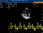 Ecocardiografia color-Doppler