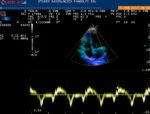 Ecocardiografia Color-Doppler