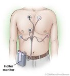 holter-ecg