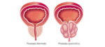 Ipertrofia prostatica benigna