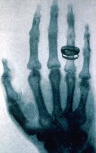 Prima radiografia, mano di Anna Berthe, moglie di Röntgen