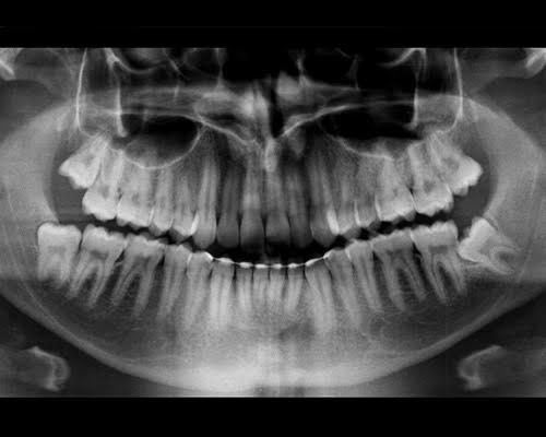 Panoramica dentaria