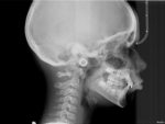 Teleradiografia del cranio LL
