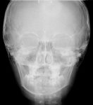 Teleradiografia del cranio PA